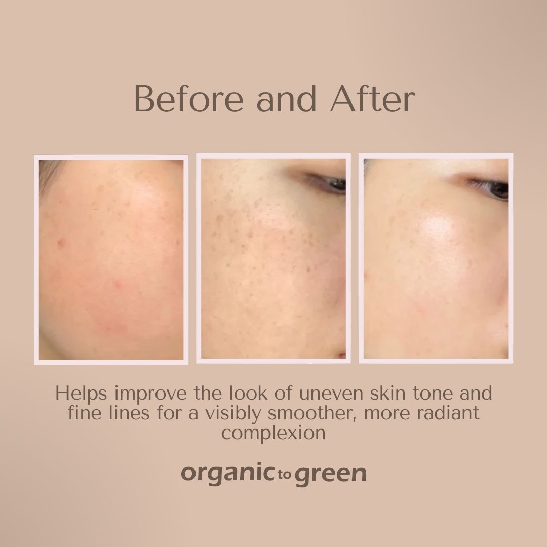 Kojic Turmeric Soap for Dark Spots - Infused with Hyaluronic Acid, Retinol, Vitamin E, Shea Butter, Collagen (3 Pack - Lemon, Fresh Ginger, and Lavender Scent)