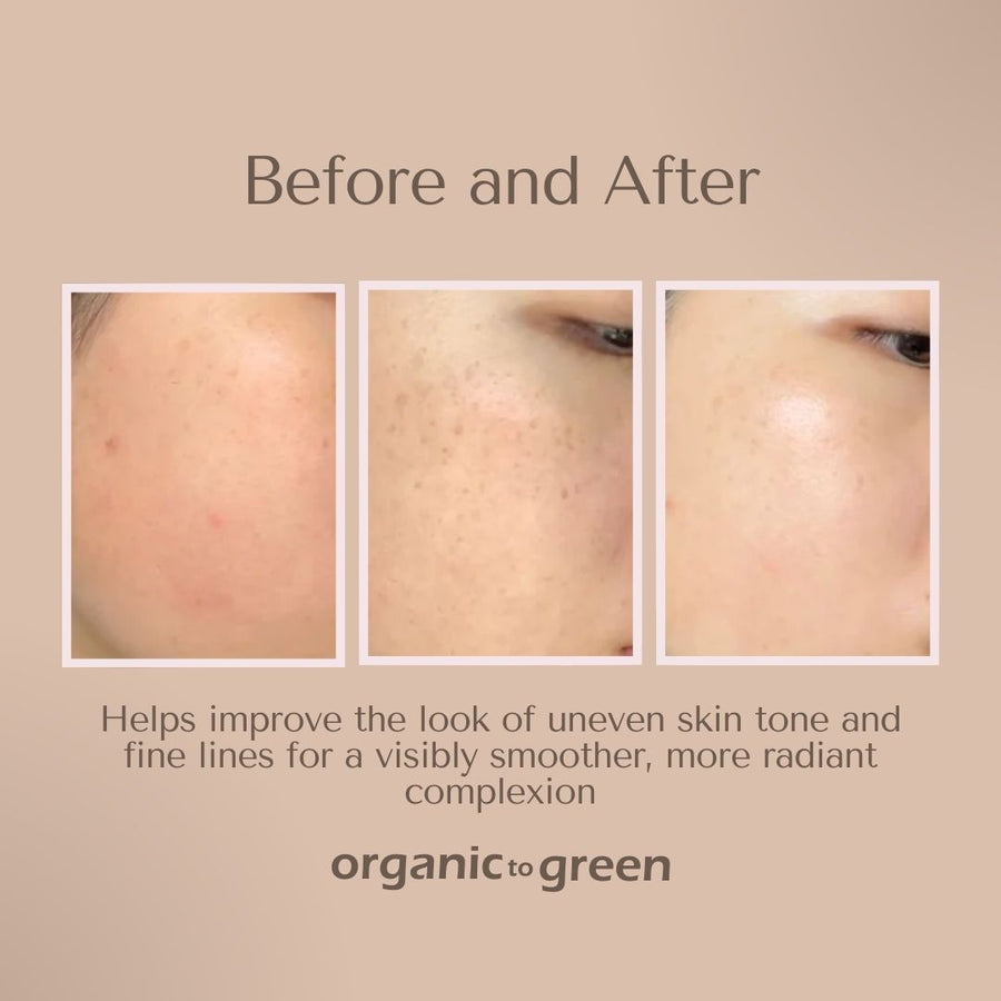 Kojic Turmeric Soap for Dark Spots - Infused with Hyaluronic Acid, Retinol, Vitamin E, Shea Butter, Collagen (3 Pack - Lemon, Fresh Ginger, and Lavender Scent)